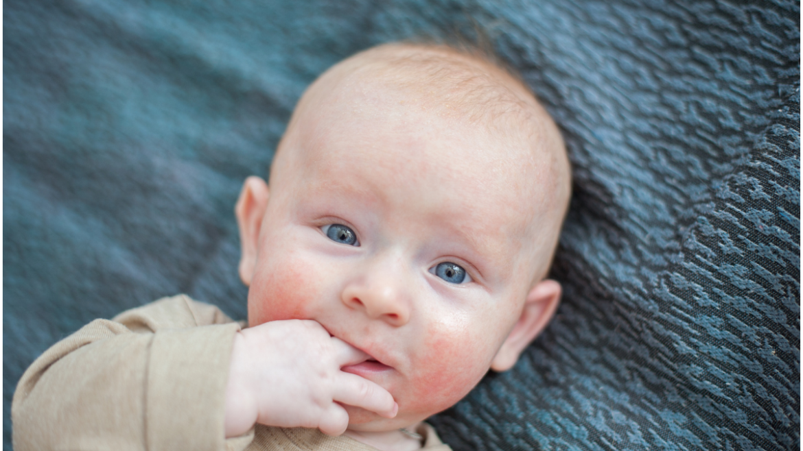 Dermatologia pediatrica