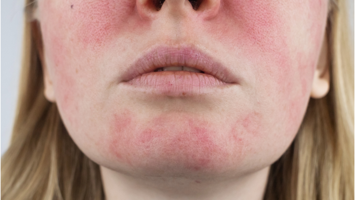 Rosacea