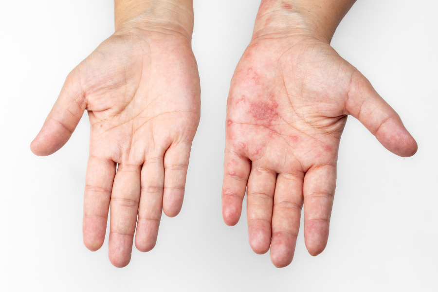 Scabbia: diagnosi, cura ed eventuale disinfestazione